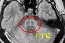 橄榄脑桥小脑萎缩的诊断要点（十字征）图片