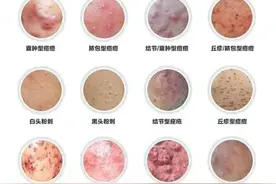 男性护肤小知识之痘痘图片