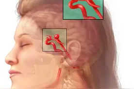 什么是脑动脉瘤？有哪些症状？医生提醒：要控制危险因素图片