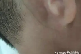 4岁男孩皮肤下有一根黑线，还会动！医生：国内仅见3例图片