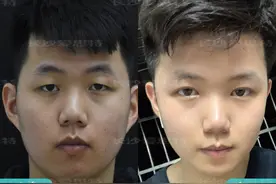 为什么要做全切双眼皮，埋线不是挺好的？图片