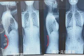 13岁少女睡姿不对 竟把脊柱睡成“S”型图片