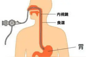 辟谣！做胃镜没有抽血查传染病，会引起交叉感染？医生告诉你真相图片