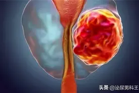 前列腺钙化对健康到底有没有影响？是否可以逆转治疗？图片