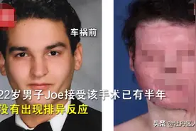 医学昌明！全球首例“换脸”手术成功图片