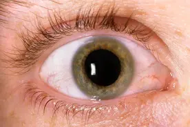 体内血糖高，眼睛先遭殃？出现这3个现象，暗示糖尿病眼已出现图片