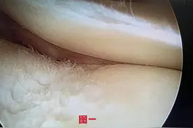 「烟花」半月板夹层破裂的危害及治疗图片
