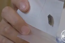 男子发现左腿有肿块，被吓得不轻，一查在身体有40年了图片