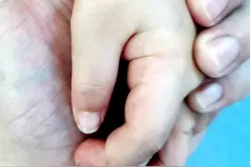 复拇指畸形矫正，不是简单的一刀切，应以长远、发展的眼光去看待图片