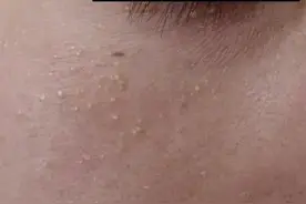 你长得真的是脂肪粒吗？如何解决“脂肪粒”？图片