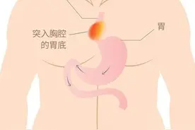 好好的胃，怎么跑到胸里了？图片