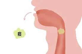 咳出黄痰、黑痰、白痰，哪一种严重？不小心咽下去的痰都去哪了？图片