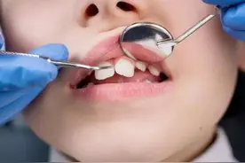 我是如何纠正孩子的牙齿外突问题的图片
