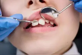 我是如何纠正孩子的牙齿外突问题的图片