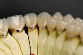 烤瓷牙还是全瓷牙？各自的优缺点是什么？图片
