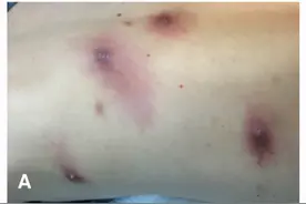 国外旅游归来的摄影师，皮肤里竟长出了小虫子，这是怎么回事？图片