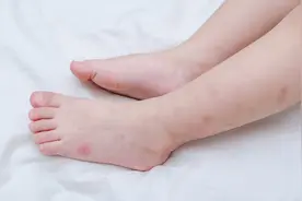 宝宝被蚊子咬后的第一步，很多家长都做错了！一定要注意图片