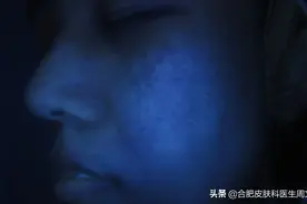 色素减退的白斑与白癜风有什么区别？图片