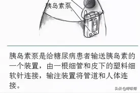胰岛素泵控糖真这么好吗？这是什么原理？图片