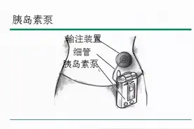 胰岛素泵控糖真这么好吗？这是什么原理？图片