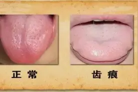 舌头胖大有齿印，中医告诉你脾虚了图片