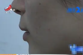 女子上班一直戴着口罩，天气一热，脸上长的东西让她很烦恼图片