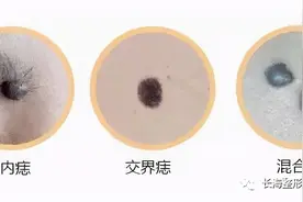 人各有“痣”，有些“问题痣”该切就得切图片