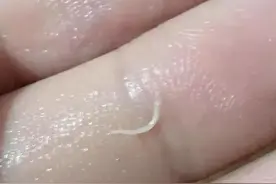 夏天还需要给孩子驱虫吗？来听听儿科医生怎么说图片