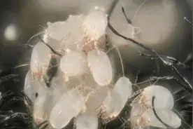 螨虫在皮肤里扎窝，脸上会有3种异常，坚持做2事，轻松清除螨虫图片