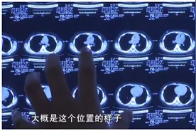6岁女童突然剧烈呛咳无法说话，医生查明原因让人哭笑不得视频封面