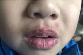 孩子嘴唇干裂、起皮还出血，多喝水也没用，医生教你正确护理方法图片