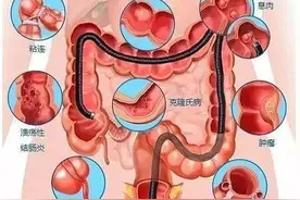 健康科普堂 | 专家教您如何做好肠镜检查准备！图片