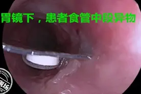她将药品带包装一起吞下！像刀片一样，划伤食道图片