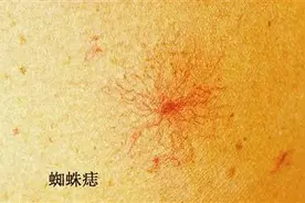 妻子发现丈夫胸前长了几个红斑，到医院检查，居然是得了肝癌图片