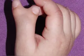 医生，我孩子的手指做完怎么还歪？图片