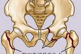 髋关节骨折怎么处理？先把脚脖子捆起来图片
