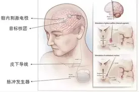 【小帕讲故事】特发性震颤手术治疗篇图片
