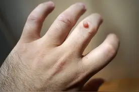 身上的瘊子是感染HPV，可能会传给孩子图片