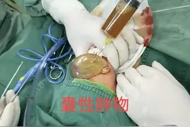 新生儿卵巢巨大囊肿，长治市妇幼保健院多学科联合救治图片