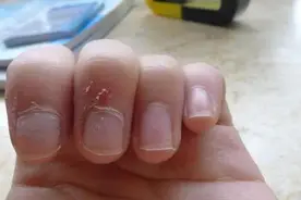 如果宝宝手上长了倒刺，要当心了，妈妈可别不在意图片