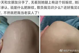 答粉丝提问：是否可以通过腹部的妊娠纹判断女性以前生过孩子？图片