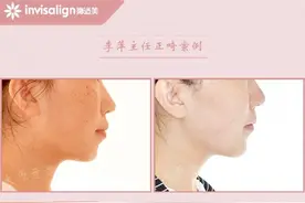 太原牙齿矫正：优先拔除坏牙，前移智齿图片