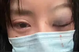 女网红疑似被男友家暴，伤势严重引网友担心，男方直接曝其猛料图片
