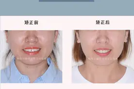青岛牙套：「前牙开颌」舌侧矫正案例图片