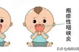 健康科普堂 | “疱疹性咽峡炎”高发期来了图片