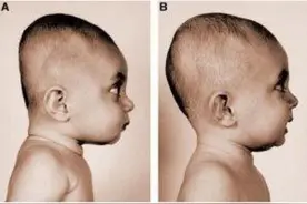 孩子扁头有福相？科学证实：扁头影响的可不仅仅是美观图片