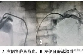 南大二附院系列科普：分侧肾静脉取血术的临床应用图片