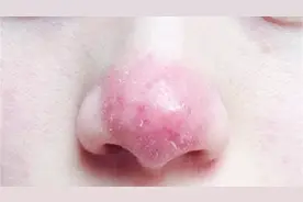 什么是玫瑰痤疮？就是俗称酒糟鼻视频封面