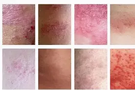 你的湿疹很可能是因为肺热导致，地上采的野菜煮煮就能治湿疹图片