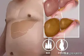 脂肪肝可能会出现这些症状图片
